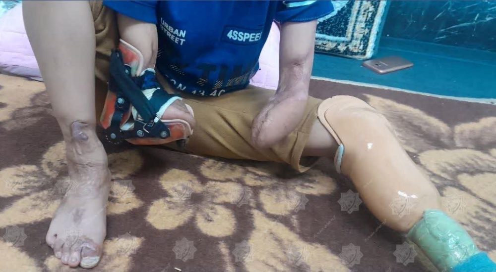 تامین هزینه جراحی دست و پا کودک معلول شده بر اثر برق گرفتگی _ دزفول